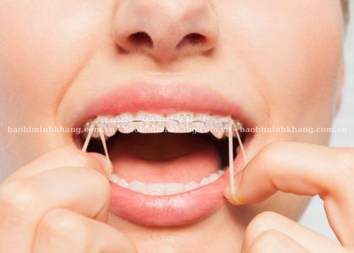 Bạn hãy tháo dây thun niềng răng trước ăn cũng như kiểm tra dây thun định kỳ để tránh nuốt phải